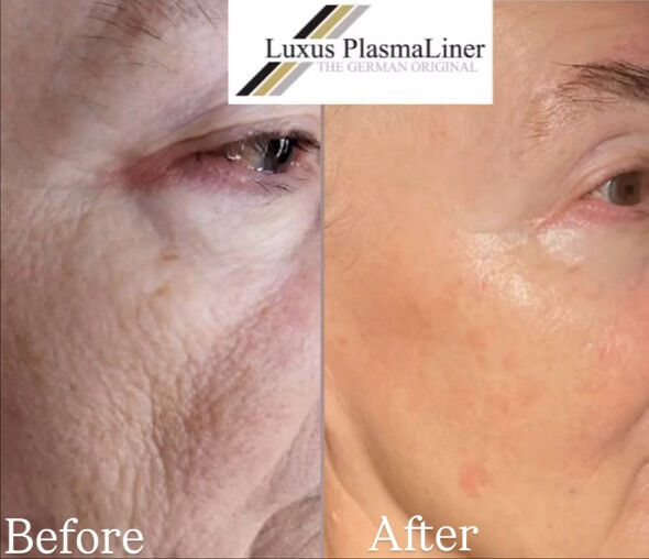 ✨ Luxus Plasma Liner — ドイツ製の先進