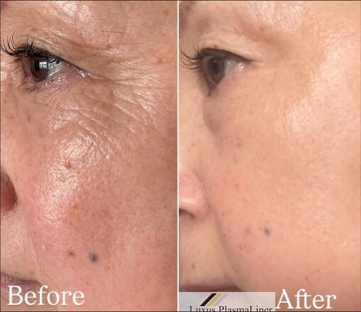 ✨ Luxus Plasma Liner — ドイツ製の先進