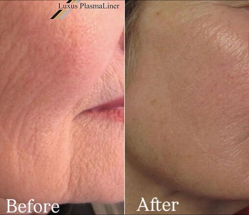 ✨ Luxus Plasma Liner — ドイツ製の先進