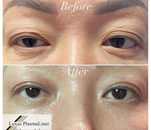 ✨ Luxus Plasma Liner — ドイツ製の先進