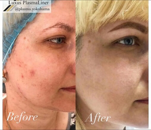 ✨ Luxus Plasma Liner — ドイツ製の先進