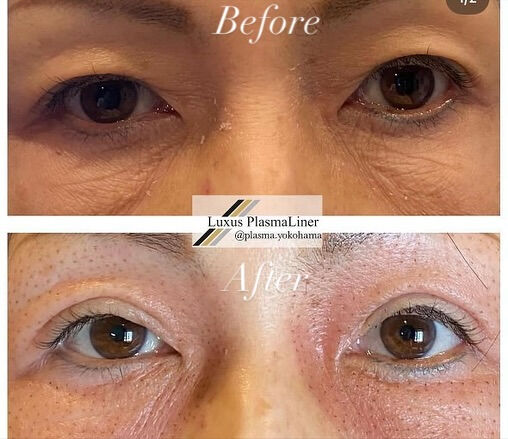 ✨ Luxus Plasma Liner — ドイツ製の先進