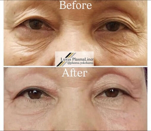 ✨ Luxus Plasma Liner — ドイツ製の先進