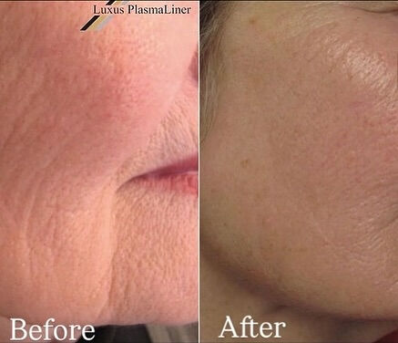 ✨ Luxus Plasma Liner — немецки