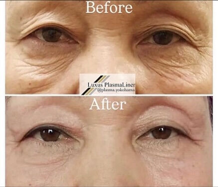 ✨ Luxus Plasma Liner — немецки
